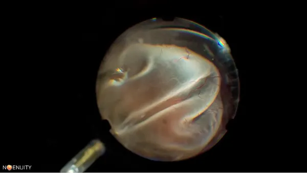 Subretinal Air thumbnail