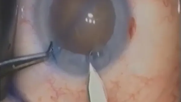 UKISCRS Choyce Medal Lecture thumbnail