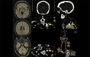 An Unusual Case of a Vertebrobasilar Transient Ischemic Attack Involving the Subclavian Steal Syndrome image