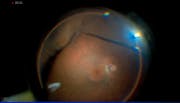 High Myopia