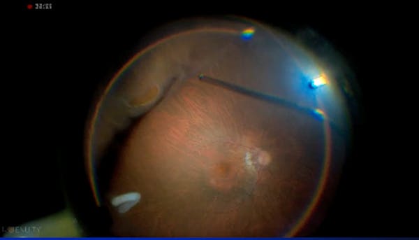 High Myopia thumbnail