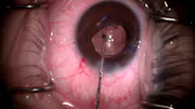 Cataract Surgery With Weak Zonules