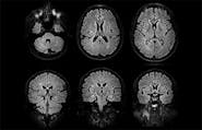 Acute Encephalopathy With Unusual Brain Lesions image