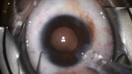 Routine Cataract Surgery Complication