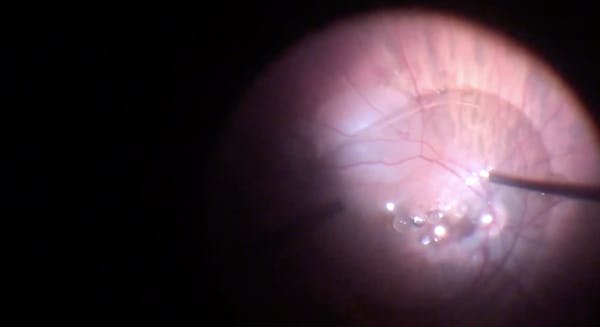 Subretinal Perfluoron thumbnail