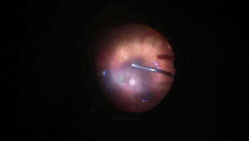 Hamartoma