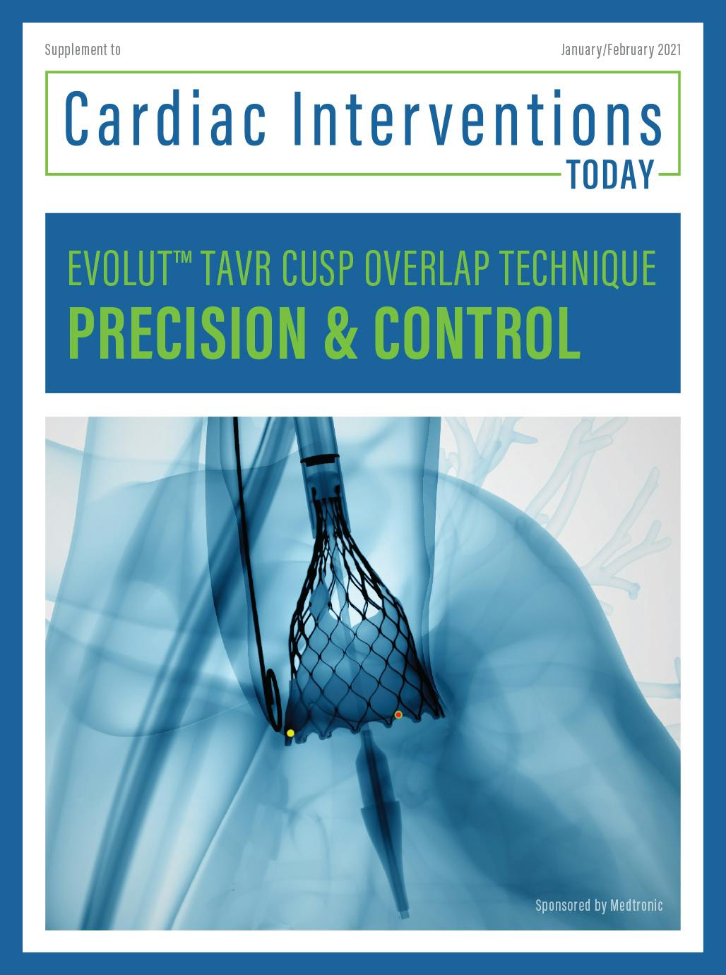 Evolut Commissural Alignment and the Cusp Overlap Technique Cardiac