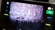 Clinical Impact of <i>Demodex</i> Blepharitis
