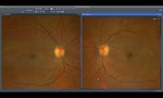 Comprehensive PDR Care with ZEISS Retina Workflow: Diagnosis, Laser Treatment, and Follow-Up