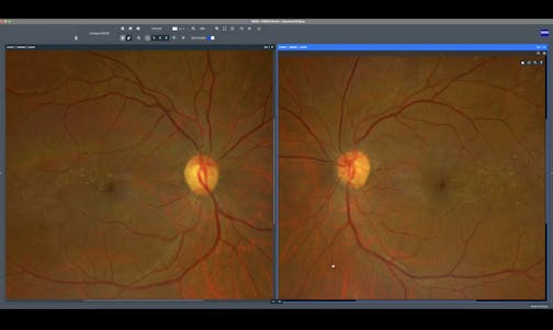 Comprehensive PDR Care with ZEISS Retina Workflow: Diagnosis, Laser Treatment, and Follow-Up