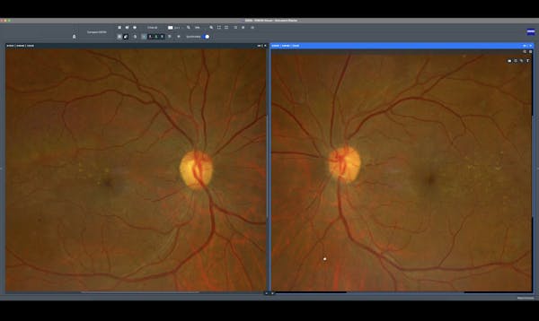 Comprehensive PDR Care with ZEISS Retina Workflow: Diagnosis, Laser Treatment, and Follow-Up thumbnail