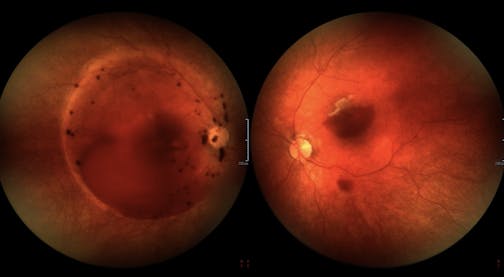 Vitreous Hemorrhage