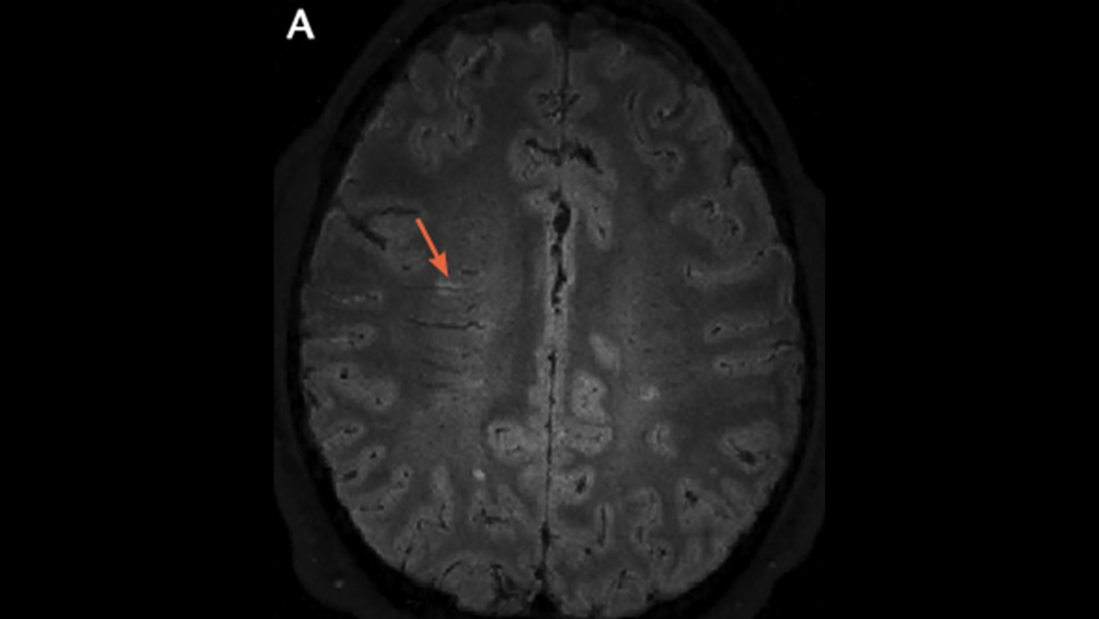 MRIとスポーツ医学 Brain MRI showed multiple bilateral subcortical white matter
