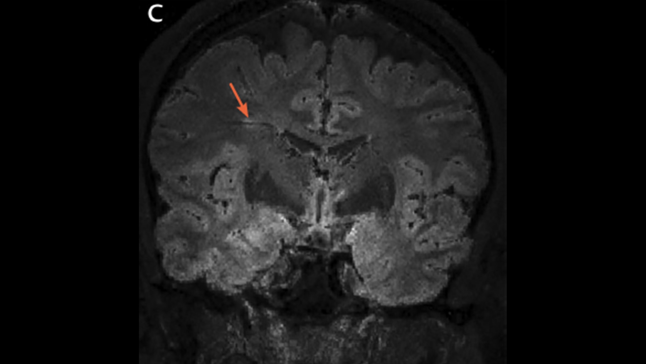 Cortical/juxtacortical Lesions - The Neurology Hub