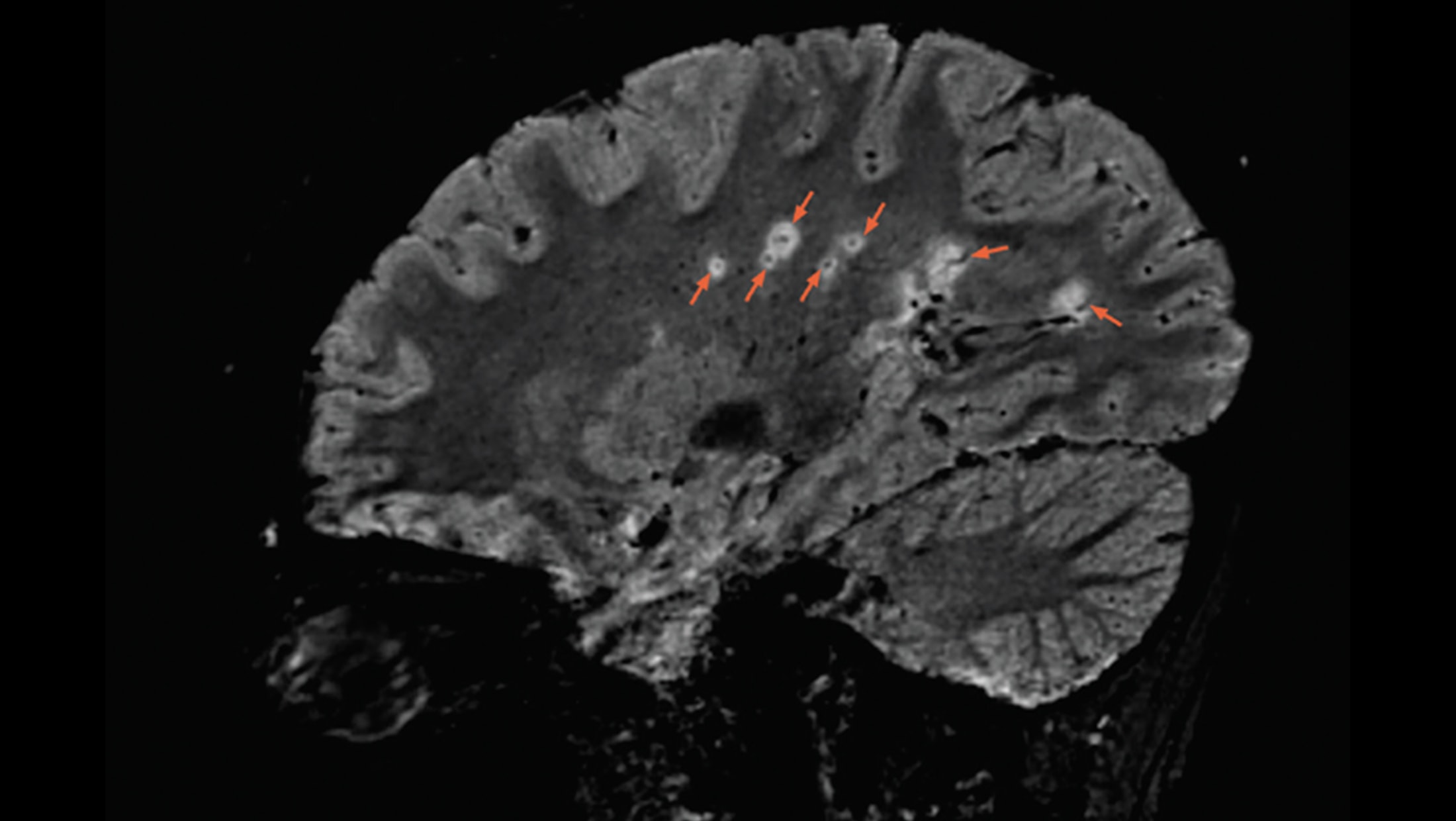 Cortical/juxtacortical Lesions - The Neurology Hub
