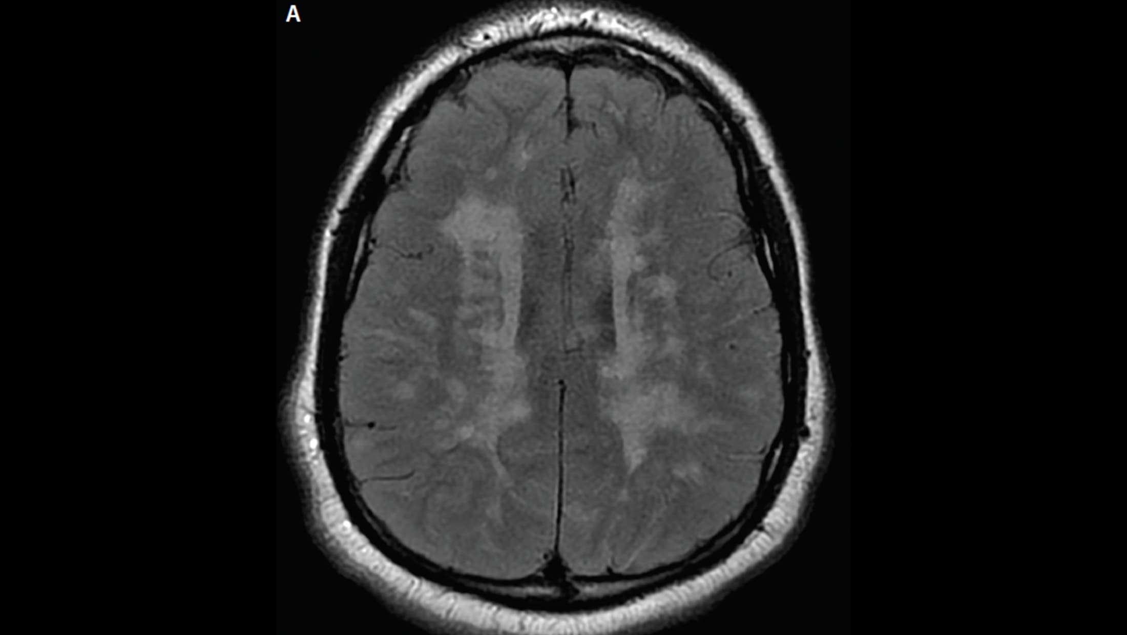 Cortical/juxtacortical Lesions - The Neurology Hub