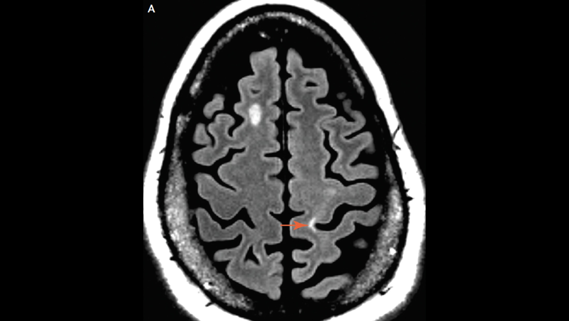 MRIとスポーツ医学 Brain MRI showed multiple bilateral subcortical white matter