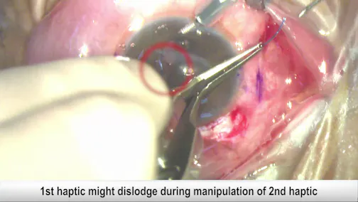The Surgical Journey of a Scleral Fixated IOL for Beginners