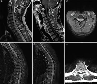 Case Report: Neuromyelitis Optica Associated With SARS-CoV-2 ...