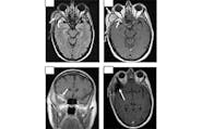 Sphenoid Wing Meningioma Presenting With a Temporal Fossa Mass image