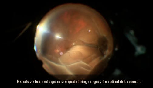Suprachoroidal Hemorrhage