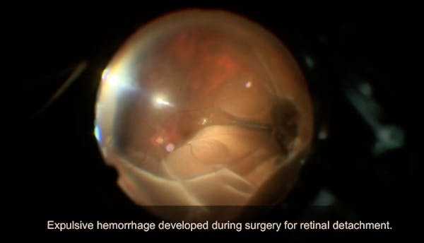 Suprachoroidal Hemorrhage thumbnail