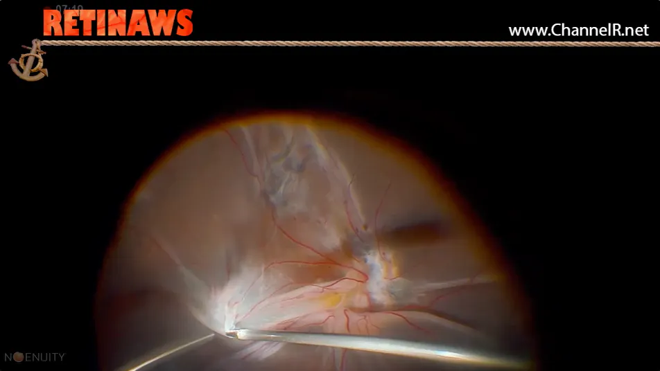 Pvr Optometry PVR - Eyetube
