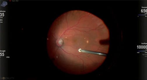 Management of Optic Disc Maculopathy