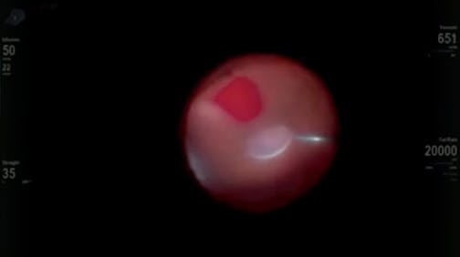 Dislocated IOL With Vitreous Hemorrhage