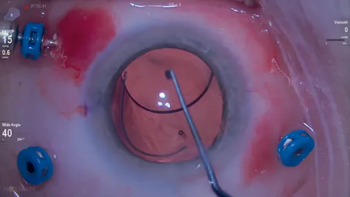 Posterior Capsule Trocar Breech
