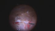 Combined Rhegmatogenous and Tractional Retinal Detachment