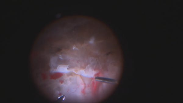 Combined Rhegmatogenous and Tractional Retinal Detachment thumbnail