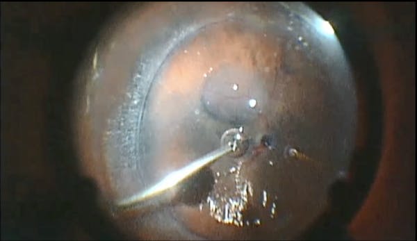 Subretinal Perfluoron thumbnail
