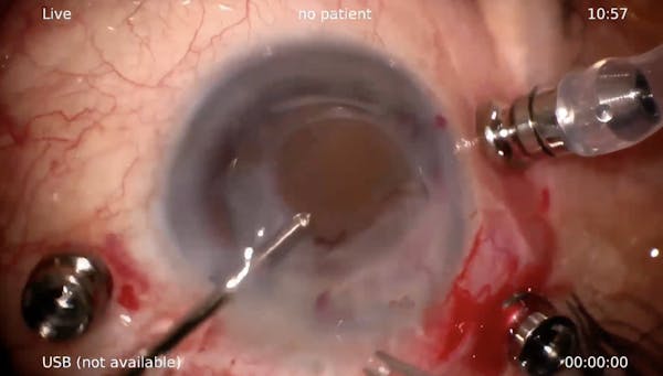 Dislocated ACIOL thumbnail