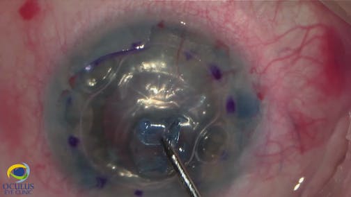 Combined Surgery After Longstanding Eyelash in Eye