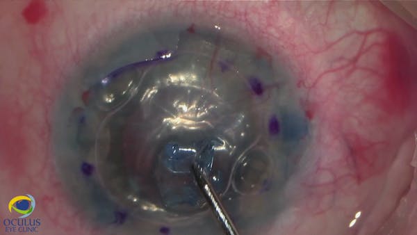 Combined Surgery After Longstanding Eyelash in Eye thumbnail