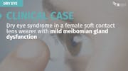 Clinical Case: Dry Eye Syndrome in a Female Soft Contact Lens Wearer with Mild MGD