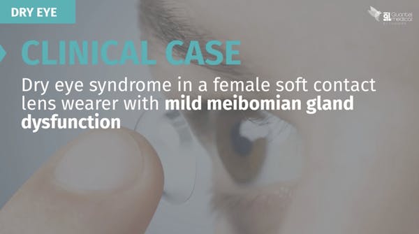 Clinical Case: Dry Eye Syndrome in a Female Soft Contact Lens Wearer with Mild MGD thumbnail