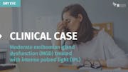 Clinical Case: Moderate Meibomian Gland Dysfunction Treated with Intense Pulsed Light (IPL)