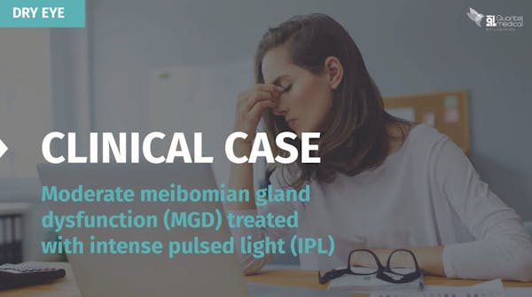 Clinical Case: Moderate Meibomian Gland Dysfunction Treated with Intense Pulsed Light (IPL) thumbnail