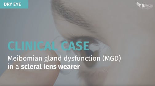 Clinical Case: Meibomian Gland Dysfunction (MGD) in a Scleral Lens Wearer