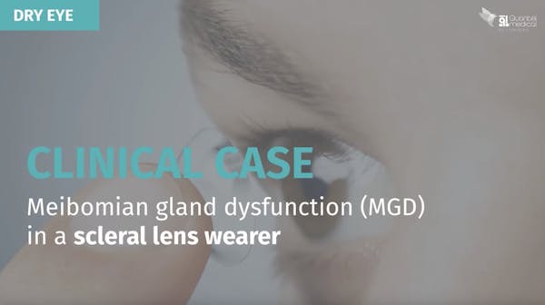 Clinical Case: Meibomian Gland Dysfunction (MGD) in a Scleral Lens Wearer thumbnail