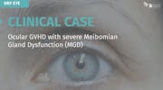 Clinical Case: Ocular GVHD with Severe Meibomian Gland Dysfunction (MGD)