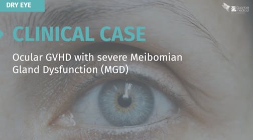 Clinical Case: Ocular GVHD with Severe Meibomian Gland Dysfunction (MGD)