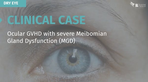 Clinical Case: Ocular GVHD with Severe Meibomian Gland Dysfunction (MGD) thumbnail