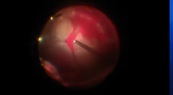 Suprachoroidal Infusion thumbnail