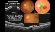 Giant Macular Hole