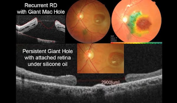 Giant Macular Hole thumbnail