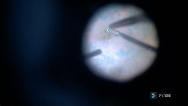 Large Macular Hole thumbnail