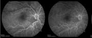 Retinal Detachment